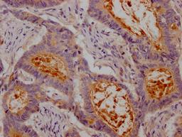 IHC image of CSB-RA147192A0HU diluted at 1:100 and staining in paraffin-embedded human colon cancer performed on a Leica BondTM system. After dewaxing and hydration, antigen retrieval was mediated by high pressure in a citrate buffer (pH 6.0). Section was blocked with 10% normal goat serum 30min at RT. Then primary antibody (1% BSA) was incubated at 4℃ overnight. The primary is detected by a Goat anti-rabbit IgG polymer labeled by HRP and visualized using 0.05% DAB.