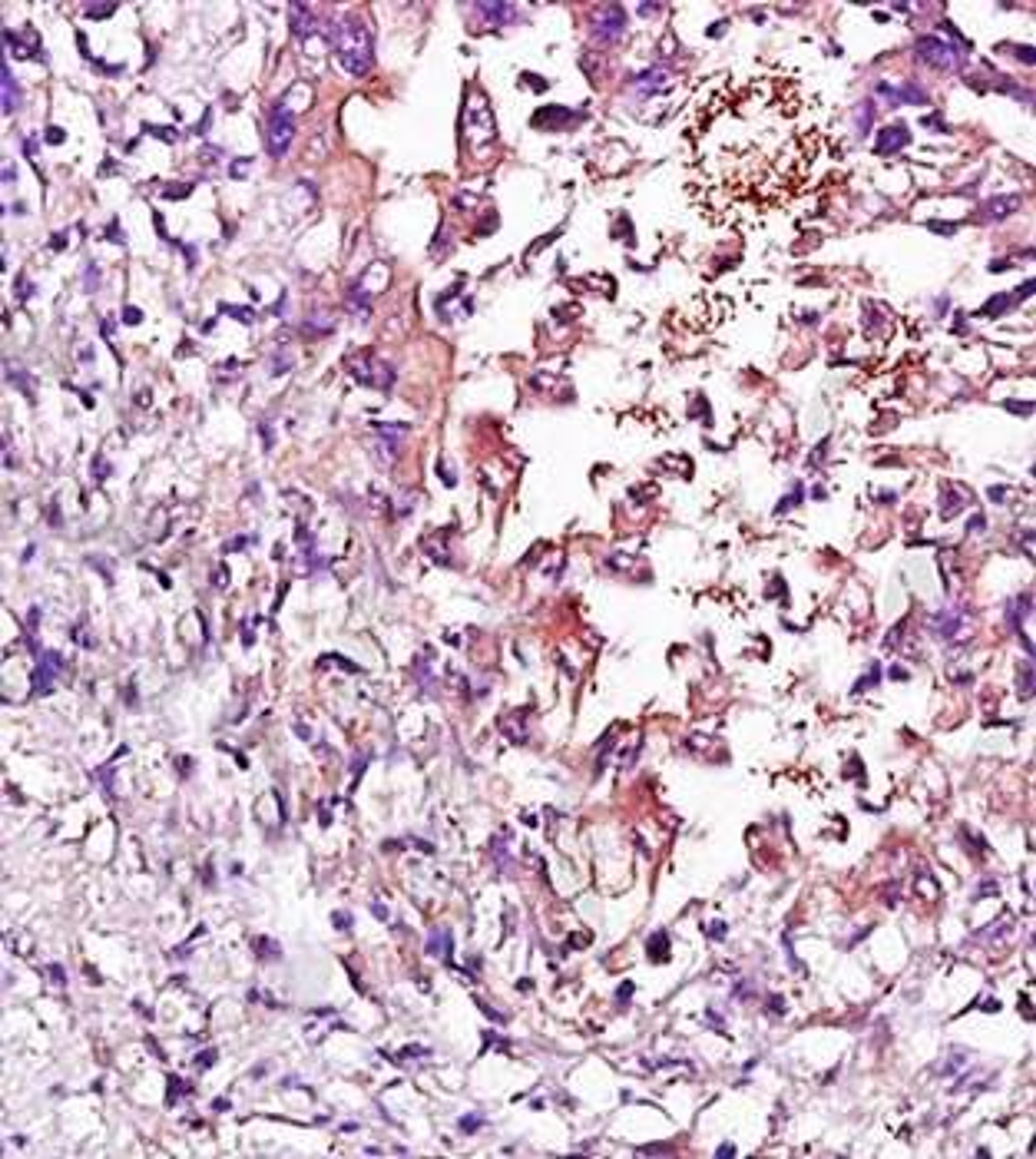 Immunohistochemical analysis of formalin fixed and paraffin embedded human esophageal carcinoma using NCAM1 antibody