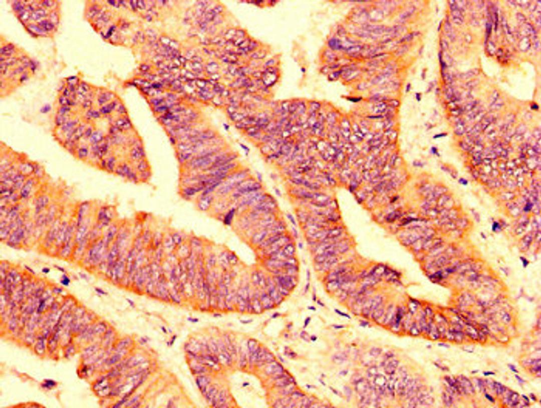 IHC image of CSB-PA018222LA01HU diluted at 1:200 and staining in paraffin-embedded human colon cancer performed on a Leica BondTM system. After dewaxing and hydration, antigen retrieval was mediated by high pressure in a citrate buffer (pH 6.0). Section was blocked with 10% normal goat serum 30min at RT. Then primary antibody (1% BSA) was incubated at 4&deg;C overnight. The primary is detected by a biotinylated secondary antibody and visualized using an HRP conjugated SP system.