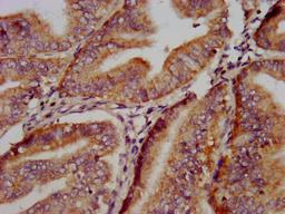 IHC image of CSB-PA856915LA01HU diluted at 1:500 and staining in paraffin-embedded human endometrial cancer performed on a Leica BondTM system. After dewaxing and hydration, antigen retrieval was mediated by high pressure in a citrate buffer (pH 6.0). Section was blocked with 10% normal goat serum 30min at RT. Then primary antibody (1% BSA) was incubated at 4&deg;C overnight. The primary is detected by a biotinylated secondary antibody and visualized using an HRP conjugated SP system.