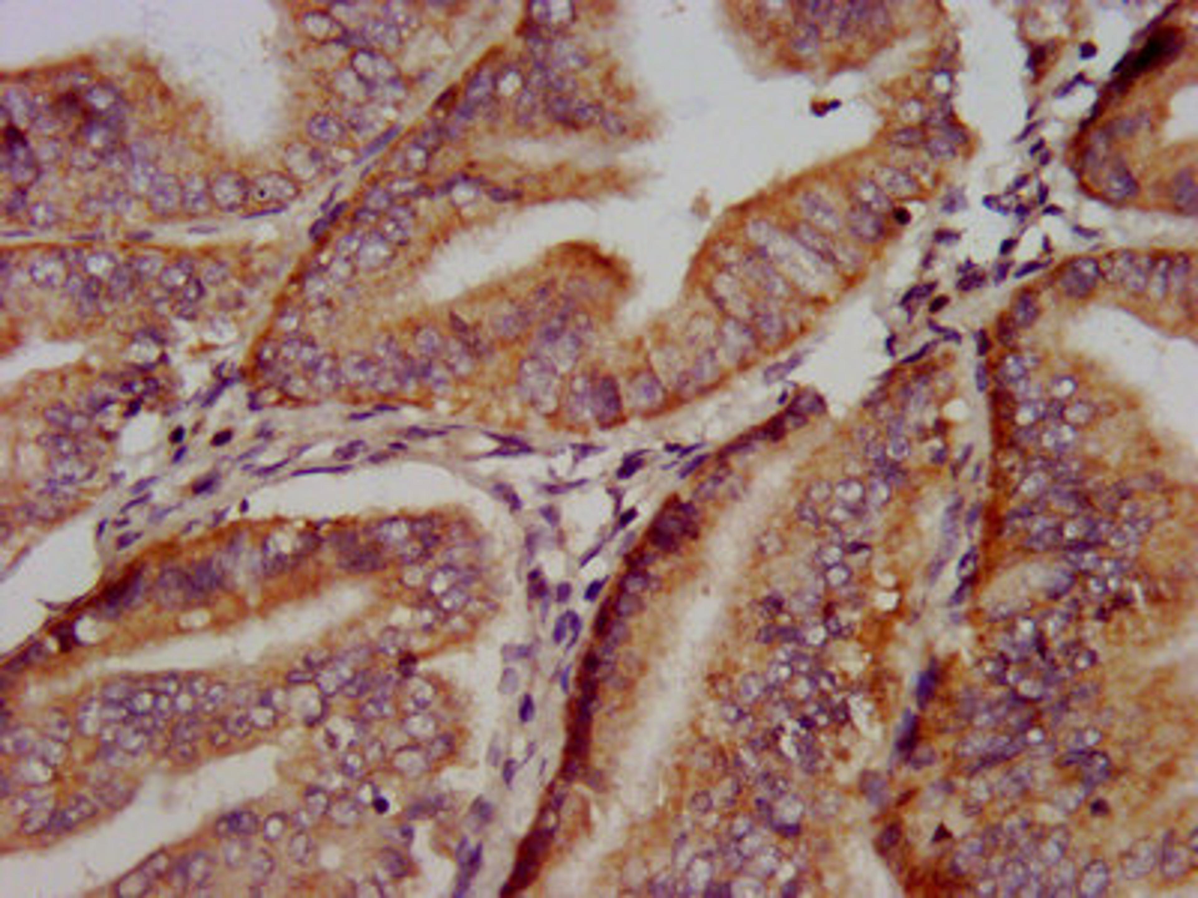 IHC image of CSB-PA856915LA01HU diluted at 1:500 and staining in paraffin-embedded human endometrial cancer performed on a Leica BondTM system. After dewaxing and hydration, antigen retrieval was mediated by high pressure in a citrate buffer (pH 6.0). Section was blocked with 10% normal goat serum 30min at RT. Then primary antibody (1% BSA) was incubated at 4&deg;C overnight. The primary is detected by a biotinylated secondary antibody and visualized using an HRP conjugated SP system.
