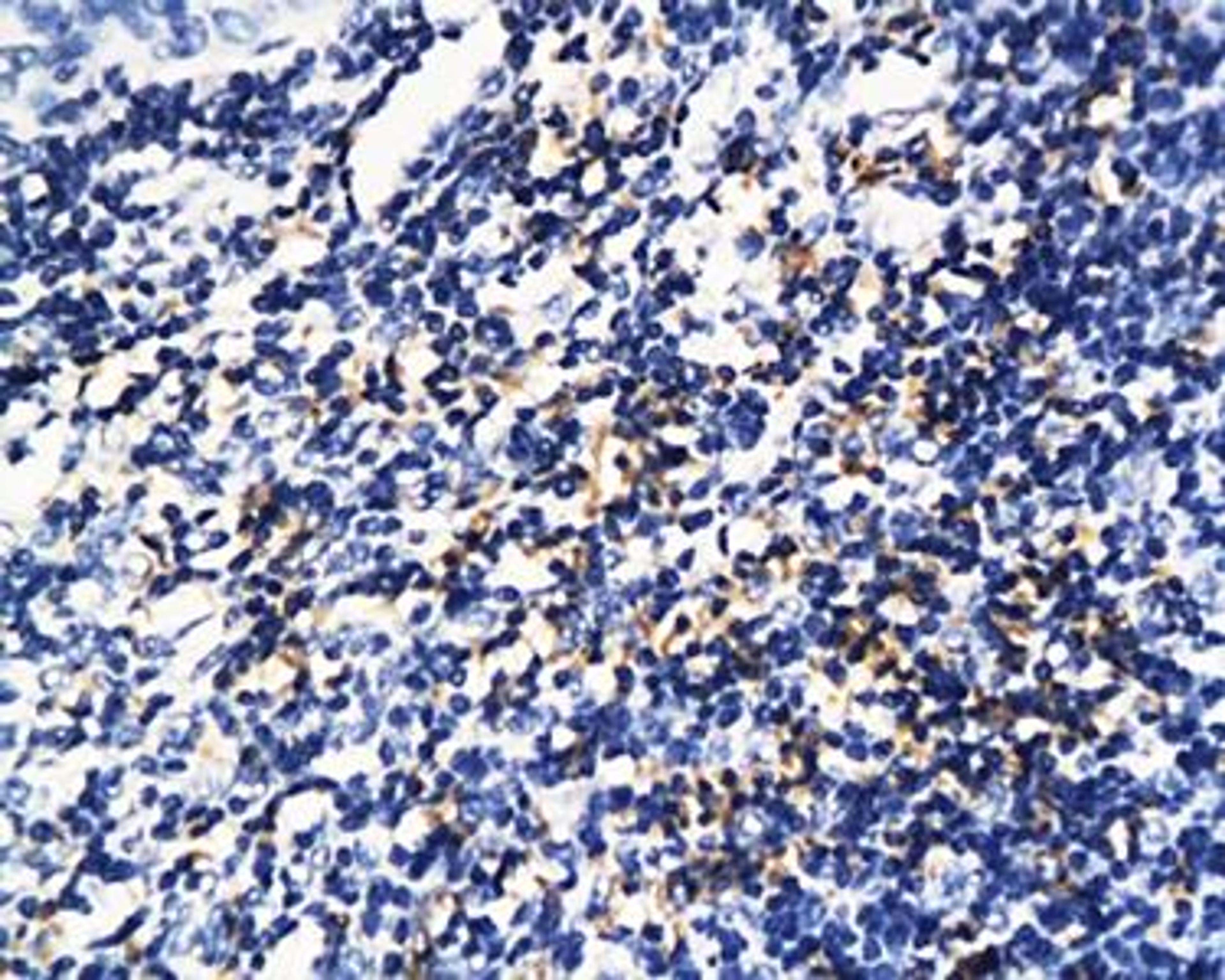 Immunohistochemical analysis of paraffin-embedded human cervical cancer tissue using PD1 antibody