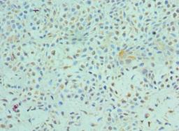 Immunohistochemistry of paraffin-embedded human breast cancer using CSB-PA007860ESR1HU at dilution of 1:100