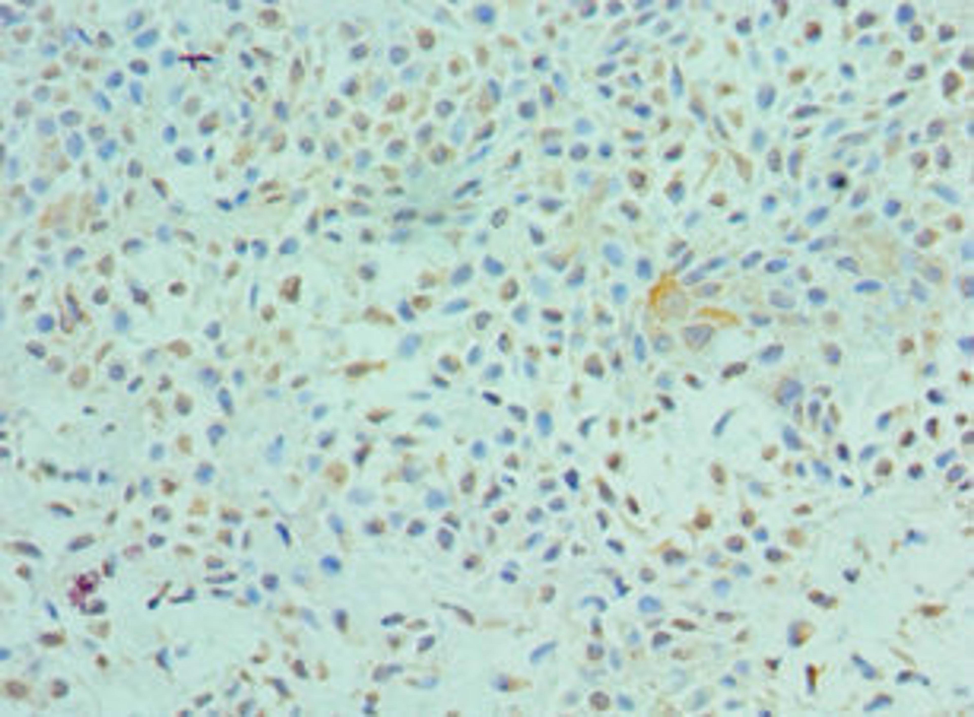 Immunohistochemistry of paraffin-embedded human breast cancer using CSB-PA007860ESR1HU at dilution of 1:100