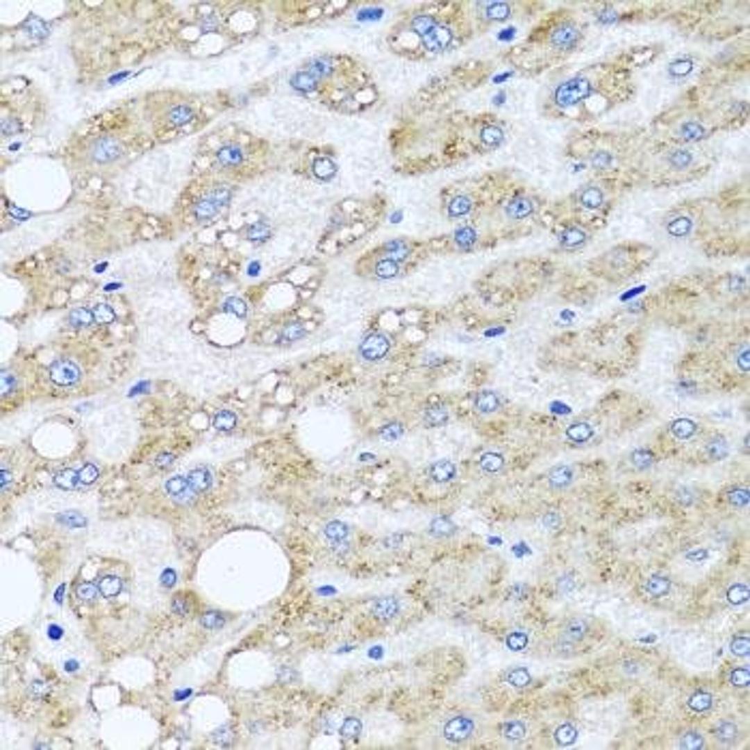 Immunohistochemical staining of human liver injury tissue using SRI antibody (dilution of 1:100)