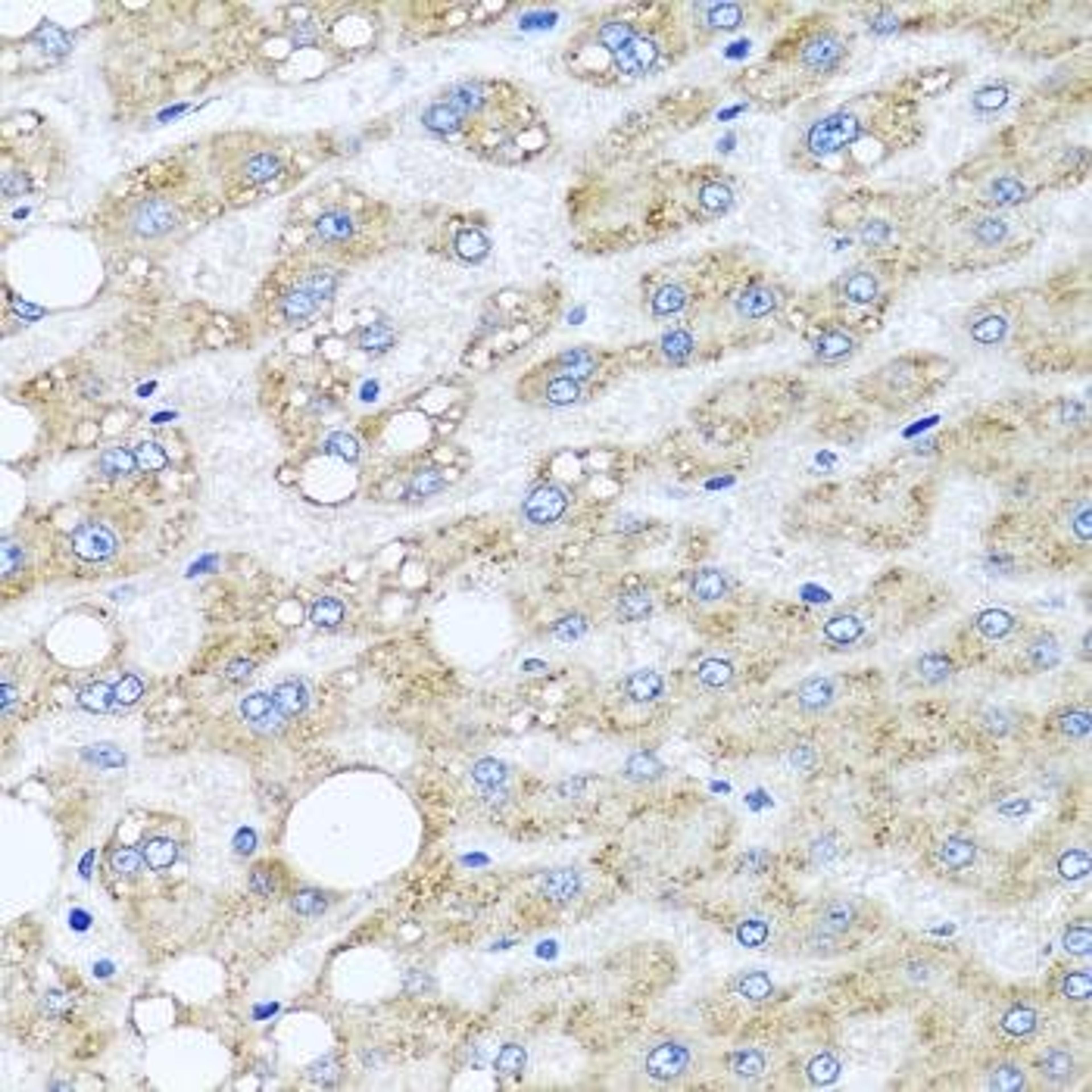 Immunohistochemical staining of human liver injury tissue using SRI antibody (dilution of 1:100)