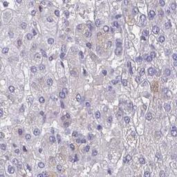 Immunohistochemistry: Kremen1 Antibody [NBP2-31617] - liver cancer