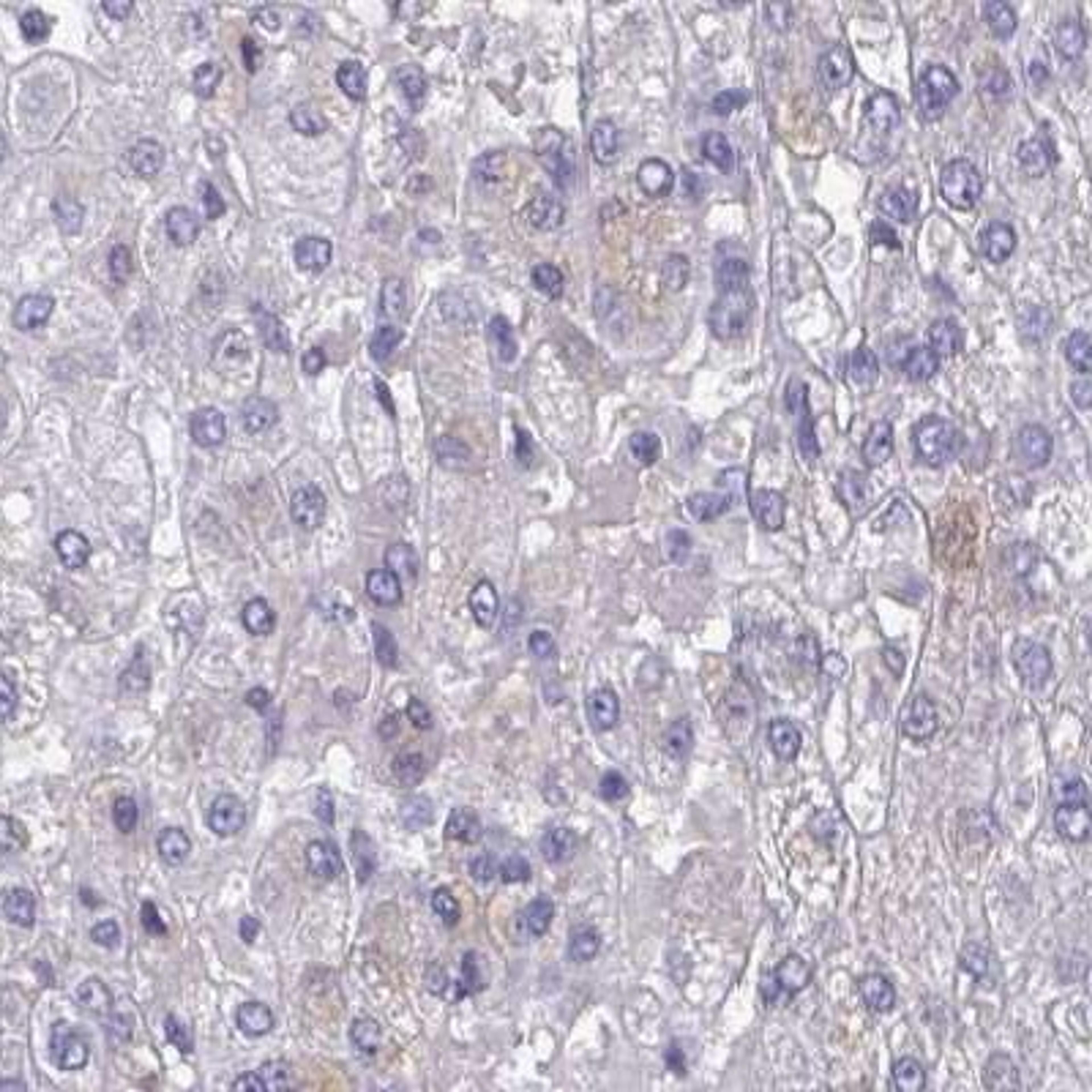 Immunohistochemistry: Kremen1 Antibody [NBP2-31617] - liver cancer