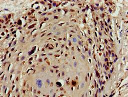 Immunohistochemistry of paraffin-embedded human cervical cancer using CSB-PA010429PA16nacHU at dilution of 1:100