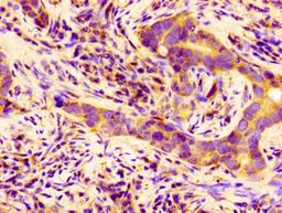 Immunohistochemistry of paraffin-embedded human pancreatic cancer using CSB-PA341920LA01HU at dilution of 1:100