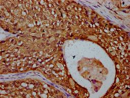 IHC image of CSB-PA883599LA01HU diluted at 1:300 and staining in paraffin-embedded human cervical cancer performed on a Leica BondTM system. After dewaxing and hydration, antigen retrieval was mediated by high pressure in a citrate buffer (pH 6.0). Section was blocked with 10% normal goat serum 30min at RT. Then primary antibody (1% BSA) was incubated at 4&deg;C overnight. The primary is detected by a biotinylated secondary antibody and visualized using an HRP conjugated SP system.