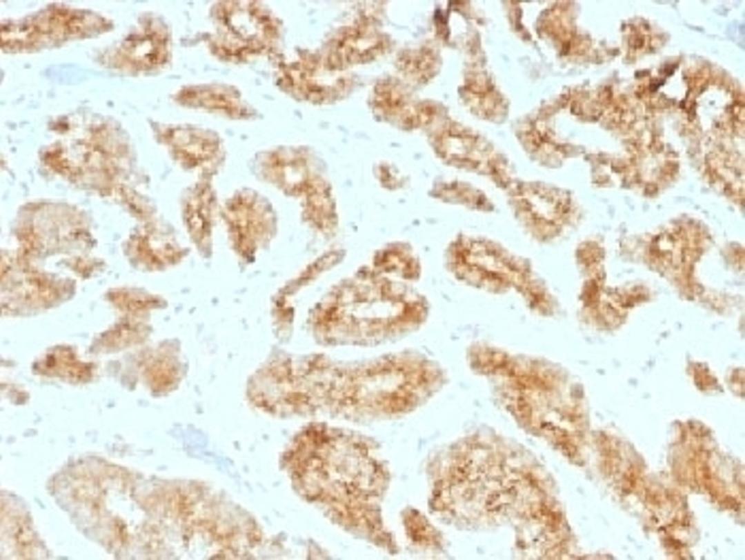 IHC testing of FFPE human prostate carcinoma with AMACR antibody (clone AMACR/1723). HIER: steam sections in pH6, 10mM citrate buffer for 10-20 min.