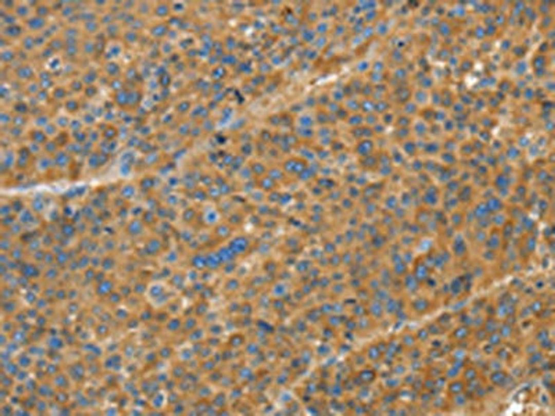 The image on the left is immunohistochemistry of paraffin-embedded Human liver cancer tissue using CSB-PA981923(TNFSF13B Antibody) at dilution 1/20, on the right is treated with fusion protein. (Original magnification: ×200)