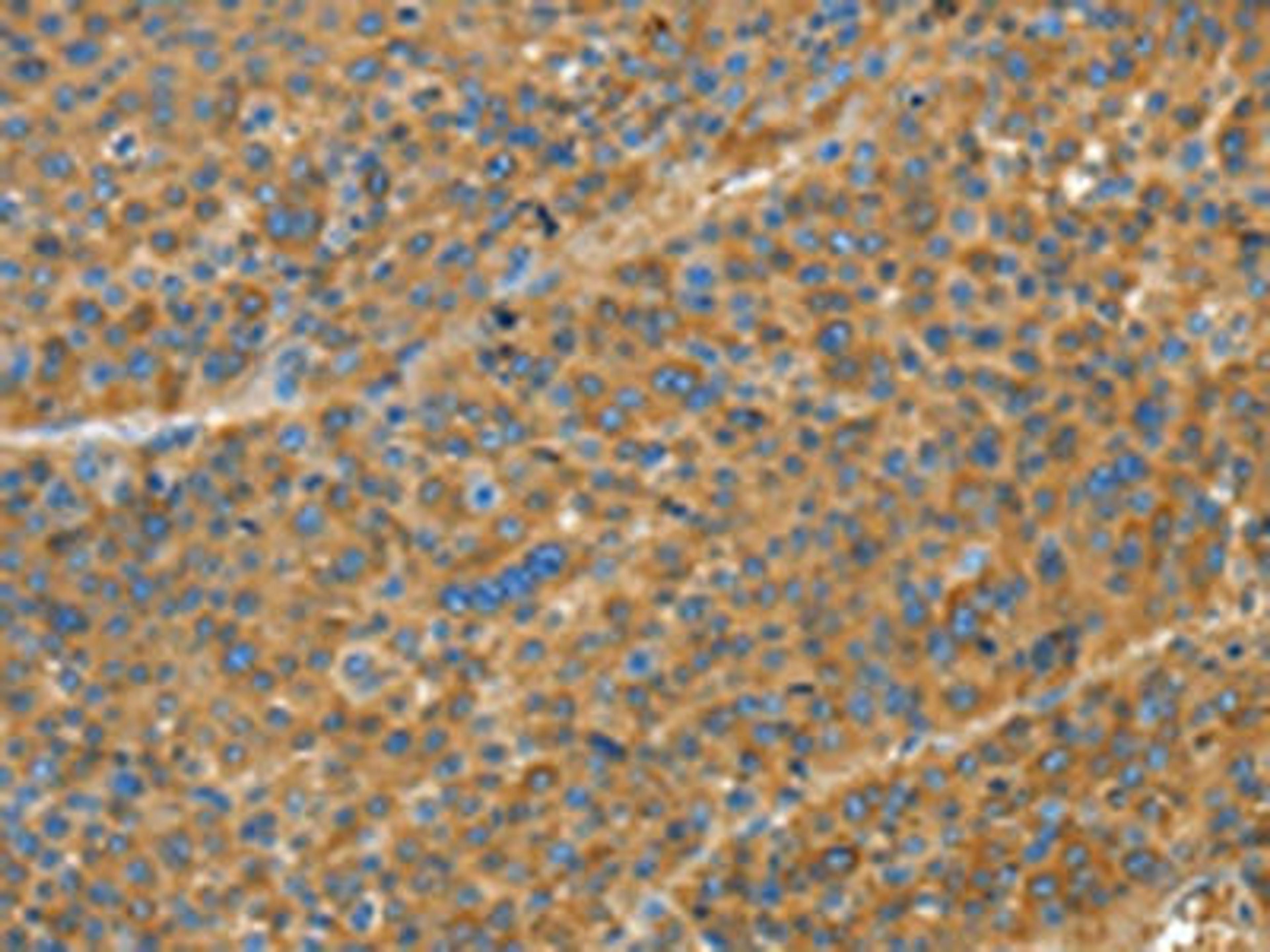 The image on the left is immunohistochemistry of paraffin-embedded Human liver cancer tissue using CSB-PA981923(TNFSF13B Antibody) at dilution 1/20, on the right is treated with fusion protein. (Original magnification: ×200)