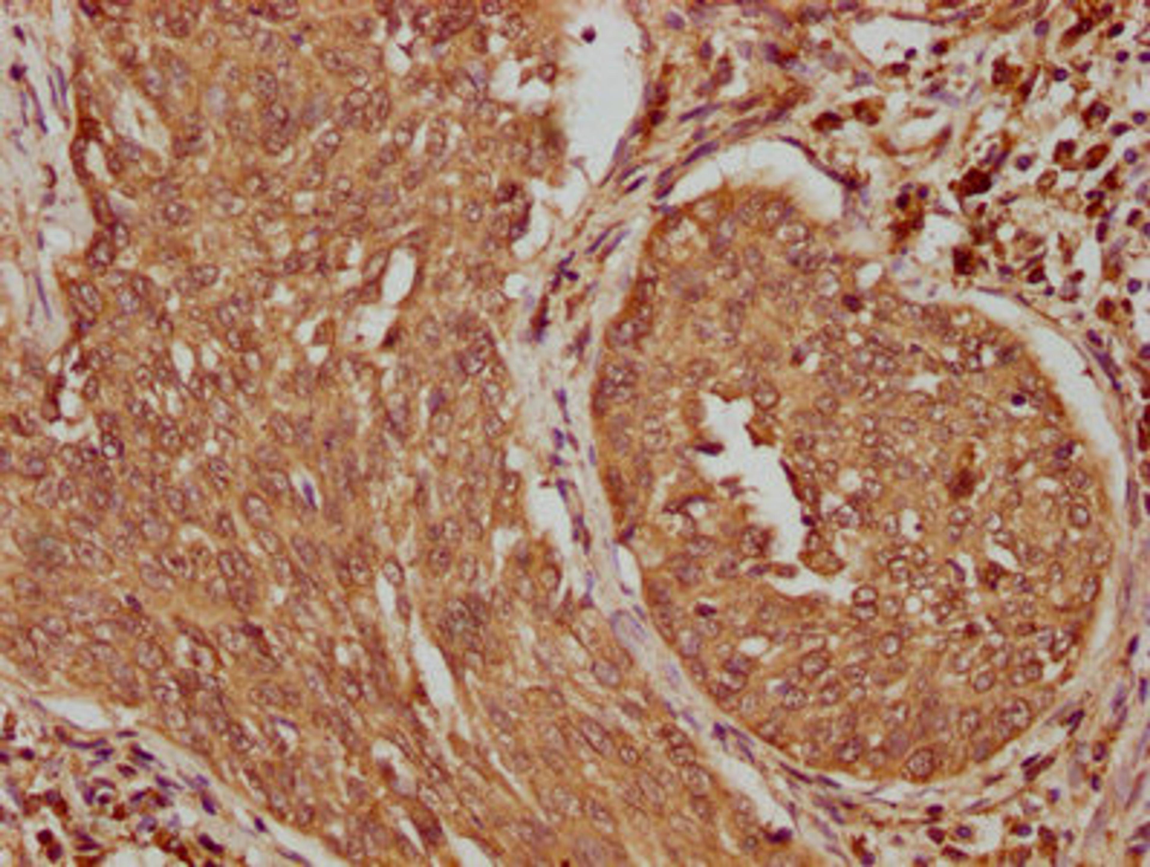 IHC image of CSB-PA406235LA01HU diluted at 1:100 and staining in paraffin-embedded human cervical cancer performed on a Leica BondTM system. After dewaxing and hydration, antigen retrieval was mediated by high pressure in a citrate buffer (pH 6.0). Section was blocked with 10% normal goat serum 30min at RT. Then primary antibody (1% BSA) was incubated at 4°C overnight. The primary is detected by a biotinylated secondary antibody and visualized using an HRP conjugated SP system.