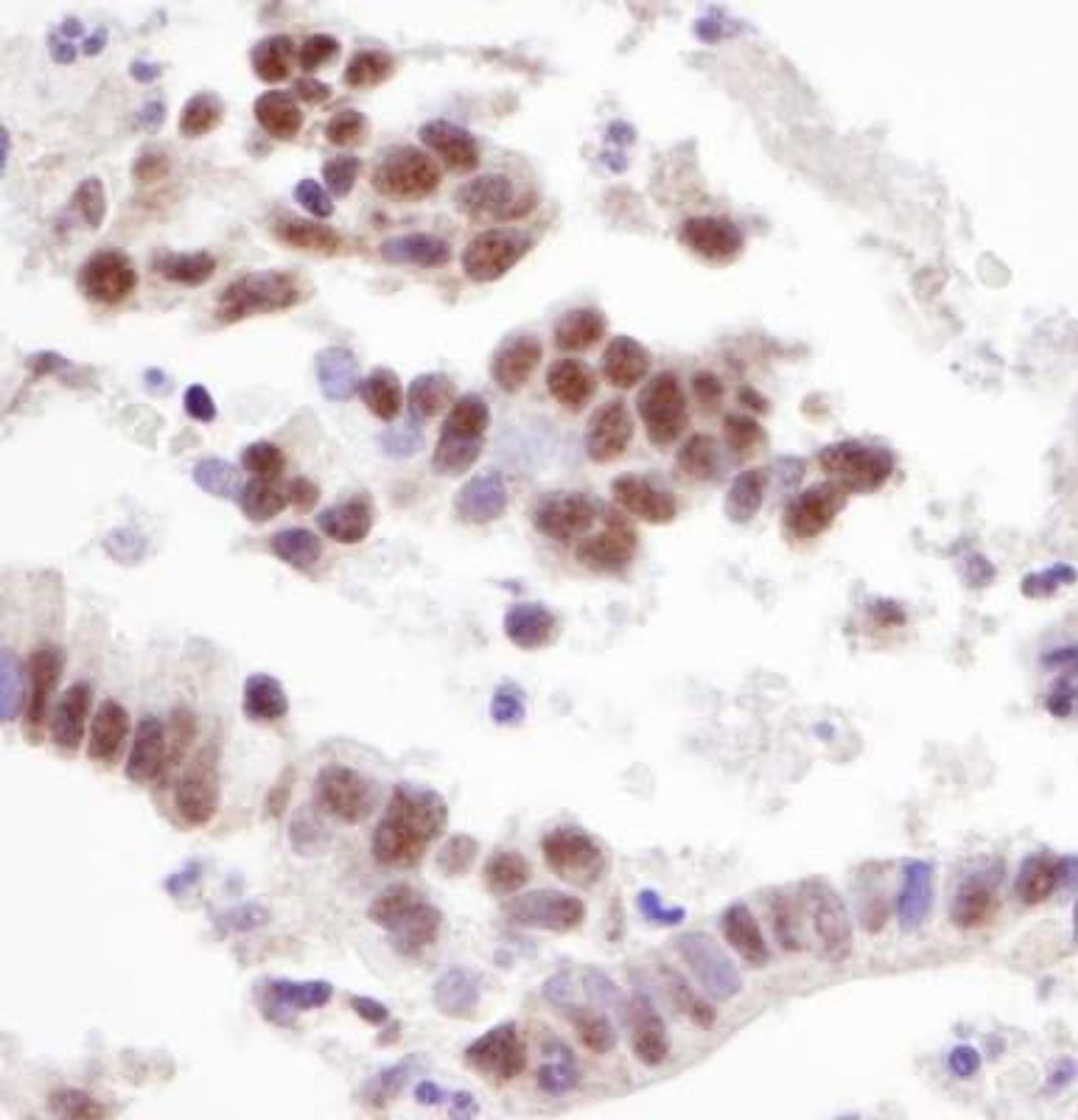 Immunohistochemistry-Paraffin: HCC1 Antibody [NB200-333] - Human stomach carcinoma. Antibody used at a dilution of 1:5,000 (0.2ug/ml).