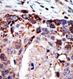 Immunohistrochemical analysis of formalin-fixed and paraffin-embedded human cancer tissue using Ataxin3 (MJD) antibody