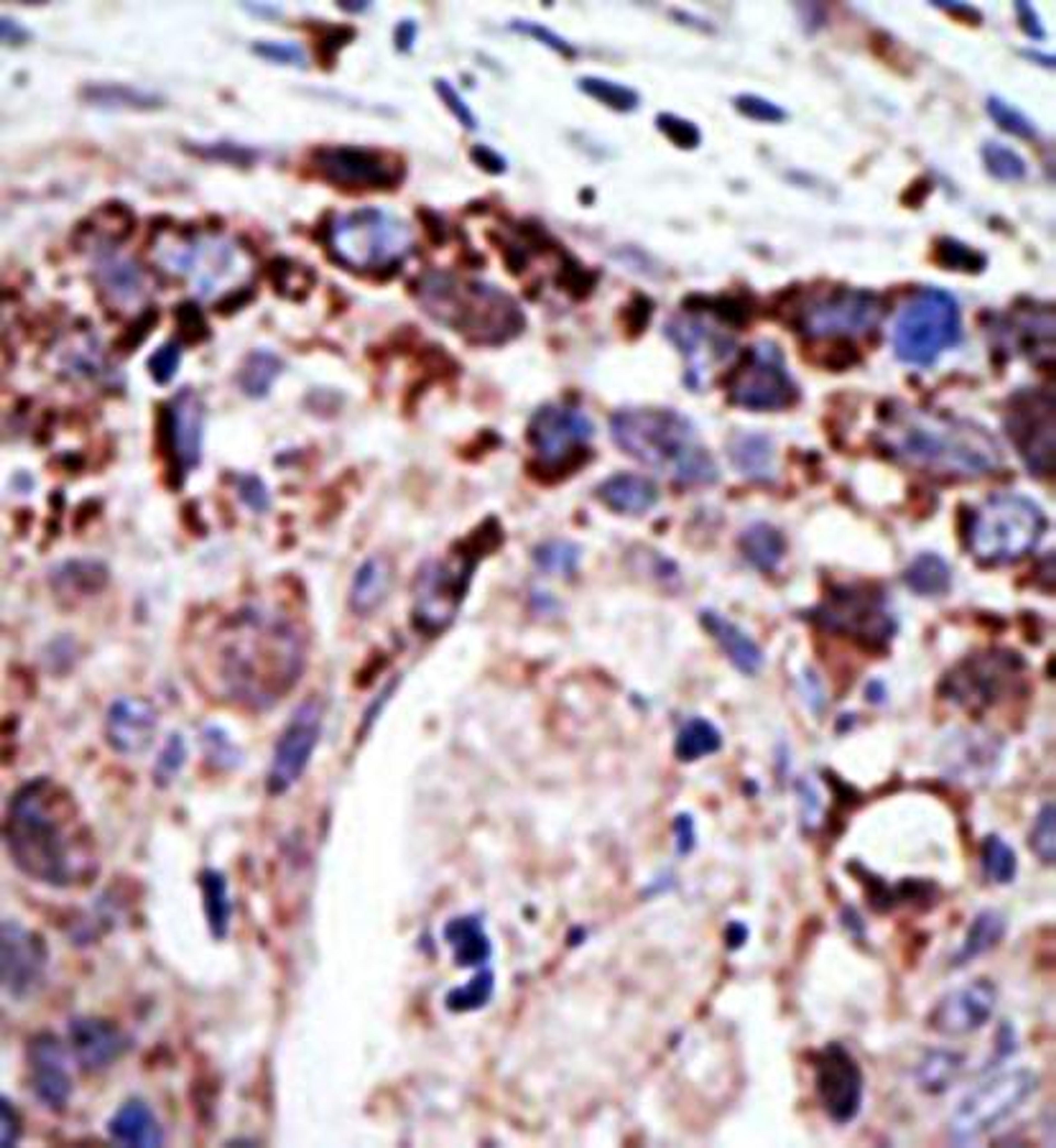 Immunohistrochemical analysis of formalin-fixed and paraffin-embedded human cancer tissue using Ataxin3 (MJD) antibody