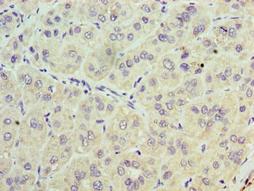 Immunohistochemistry of paraffin-embedded human liver cancer using CSB-PA024291LA01HU at dilution of 1:100