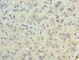 Immunohistochemistry of paraffin-embedded human liver cancer using CSB-PA024291LA01HU at dilution of 1:100