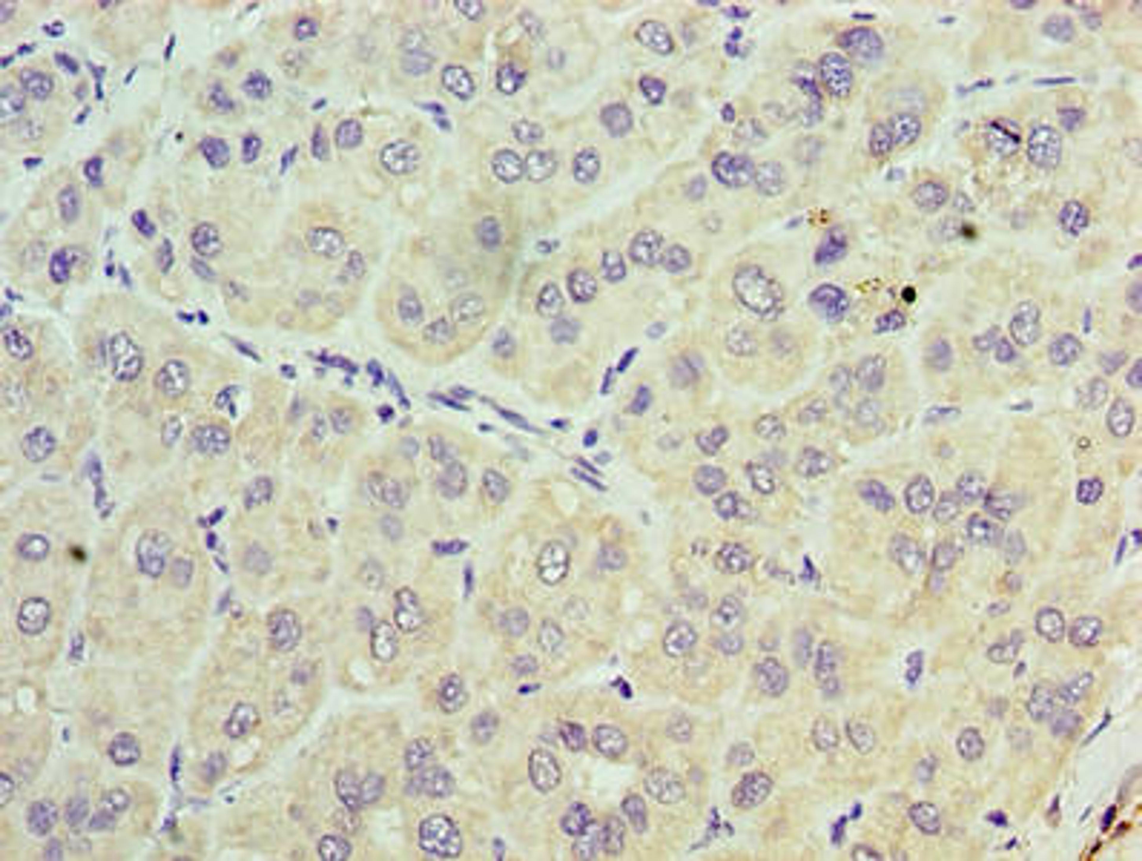 Immunohistochemistry of paraffin-embedded human liver cancer using CSB-PA024291LA01HU at dilution of 1:100