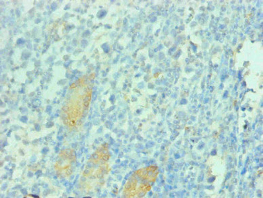 Immunohistochemical of paraffin-embedded human gastric cancer tissue using  CSB-MA112991A0m at dilution of 1:200  