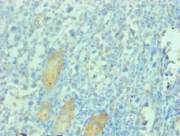 Immunohistochemical of paraffin-embedded human gastric cancer tissue using  CSB-MA112991A0m at dilution of 1:200  