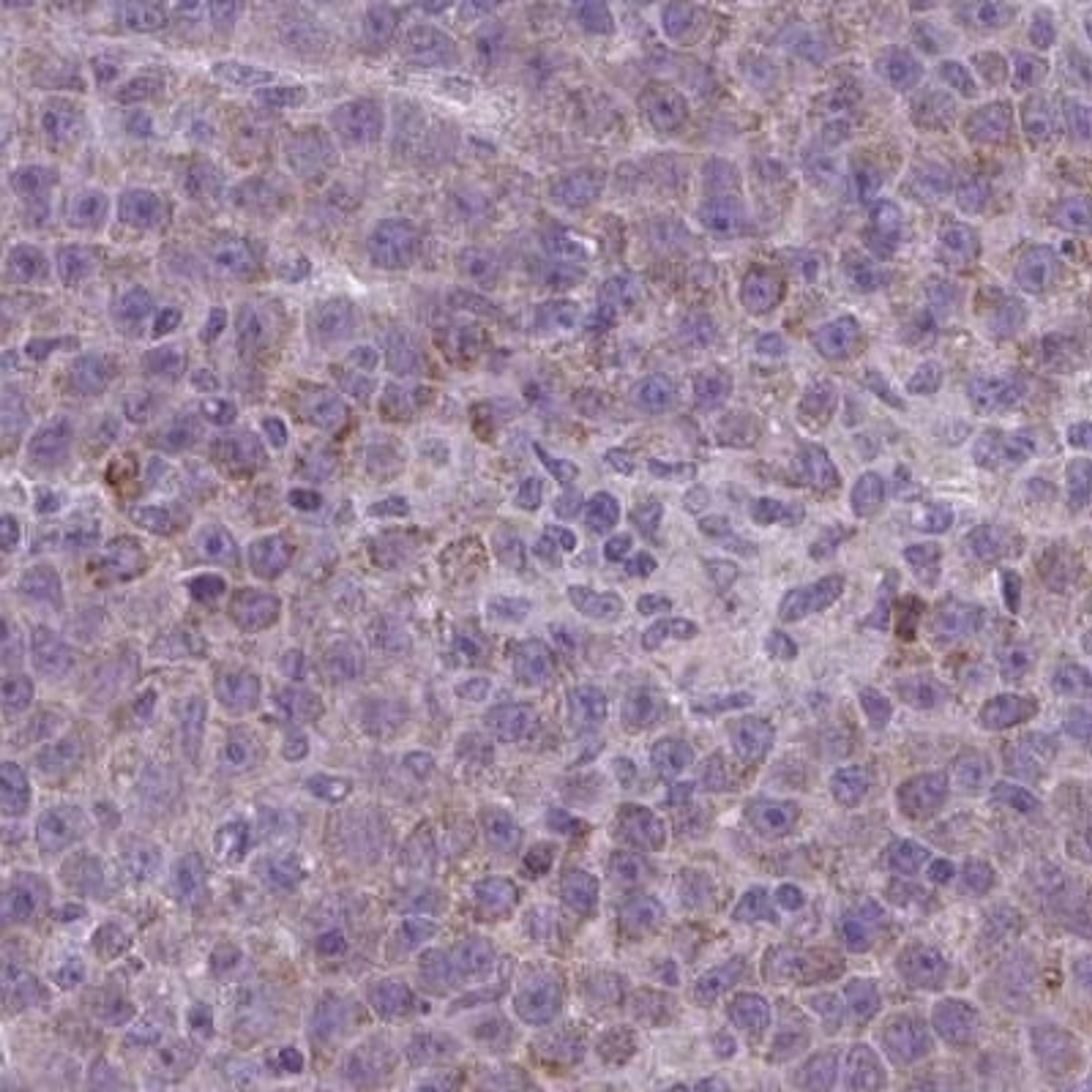 Immunohistochemistry: C2orf68 Antibody [NBP2-31905] - liver cancer