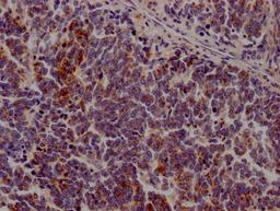 IHC image of CSB-RA206737A0HU diluted at 1:100 and staining in paraffin-embedded human lung cancer performed on a Leica BondTM system. After dewaxing and hydration, antigen retrieval was mediated by high pressure in a citrate buffer (pH 6.0). Section was blocked with 10% normal goat serum 30min at RT. Then primary antibody (1% BSA) was incubated at 4℃ overnight. The primary is detected by a Goat anti-rabbit IgG polymer labeled by HRP and visualized using 0.05% DAB.