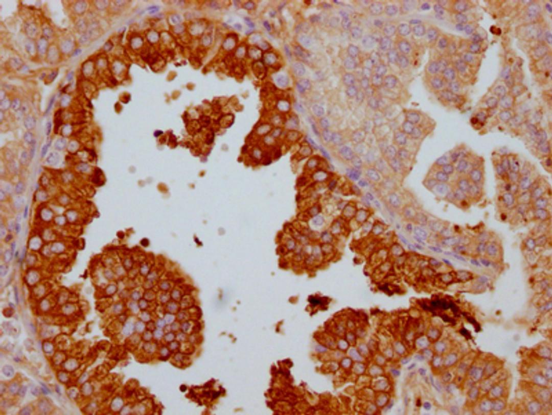 IHC image of CSB-RA697089A0HU diluted at 1:100 and staining in paraffin-embedded human prostate cancer performed on a Leica BondTM system. After dewaxing and hydration, antigen retrieval was mediated by high pressure in a citrate buffer (pH 6.0). Section was blocked with 10% normal goat serum 30min at RT. Then primary antibody (1% BSA) was incubated at 4℃ overnight. The primary is detected by a Goat anti-rabbit IgG polymer labeled by HRP and visualized using 0.05% DAB.