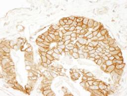 Detection of human beta Catenin by immunohistochemistry.