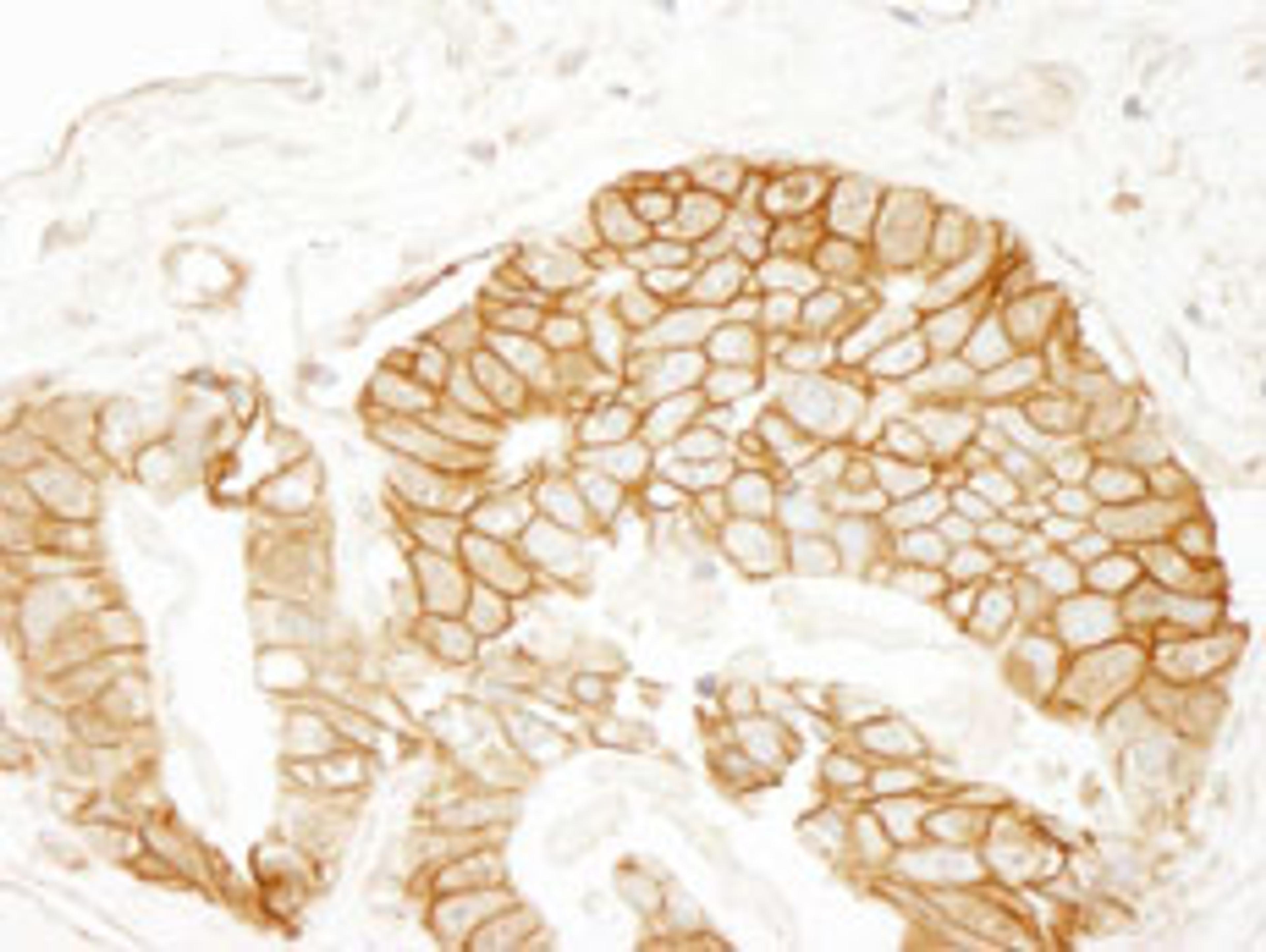 Detection of human beta Catenin by immunohistochemistry.