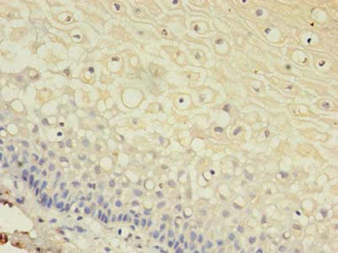 Immunohistochemistry of paraffin-embedded human cervical cancer using CSB-PA009453LA01HU at dilution of 1:100