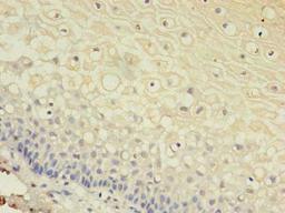 Immunohistochemistry of paraffin-embedded human cervical cancer using CSB-PA009453LA01HU at dilution of 1:100