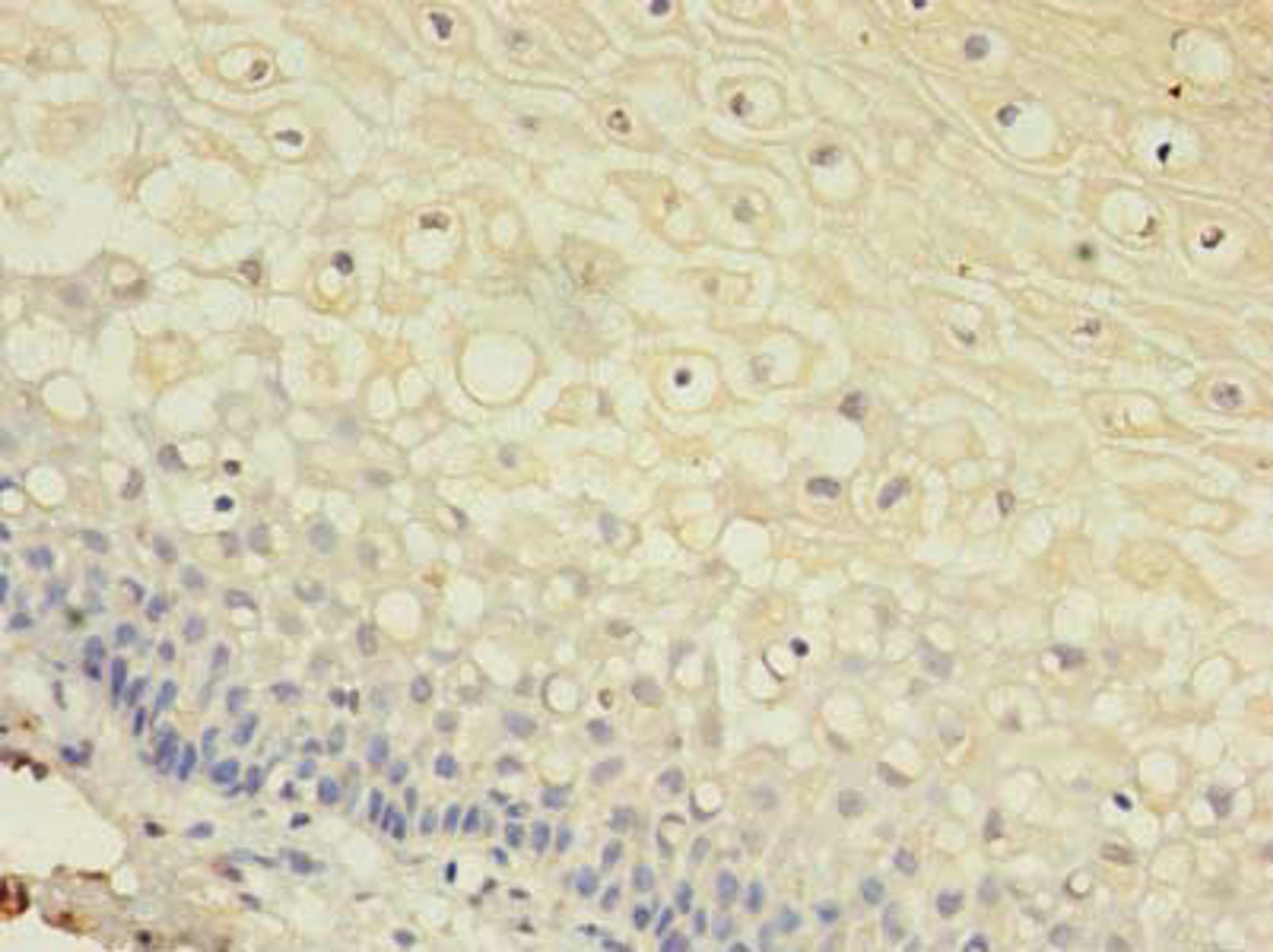 Immunohistochemistry of paraffin-embedded human cervical cancer using CSB-PA009453LA01HU at dilution of 1:100