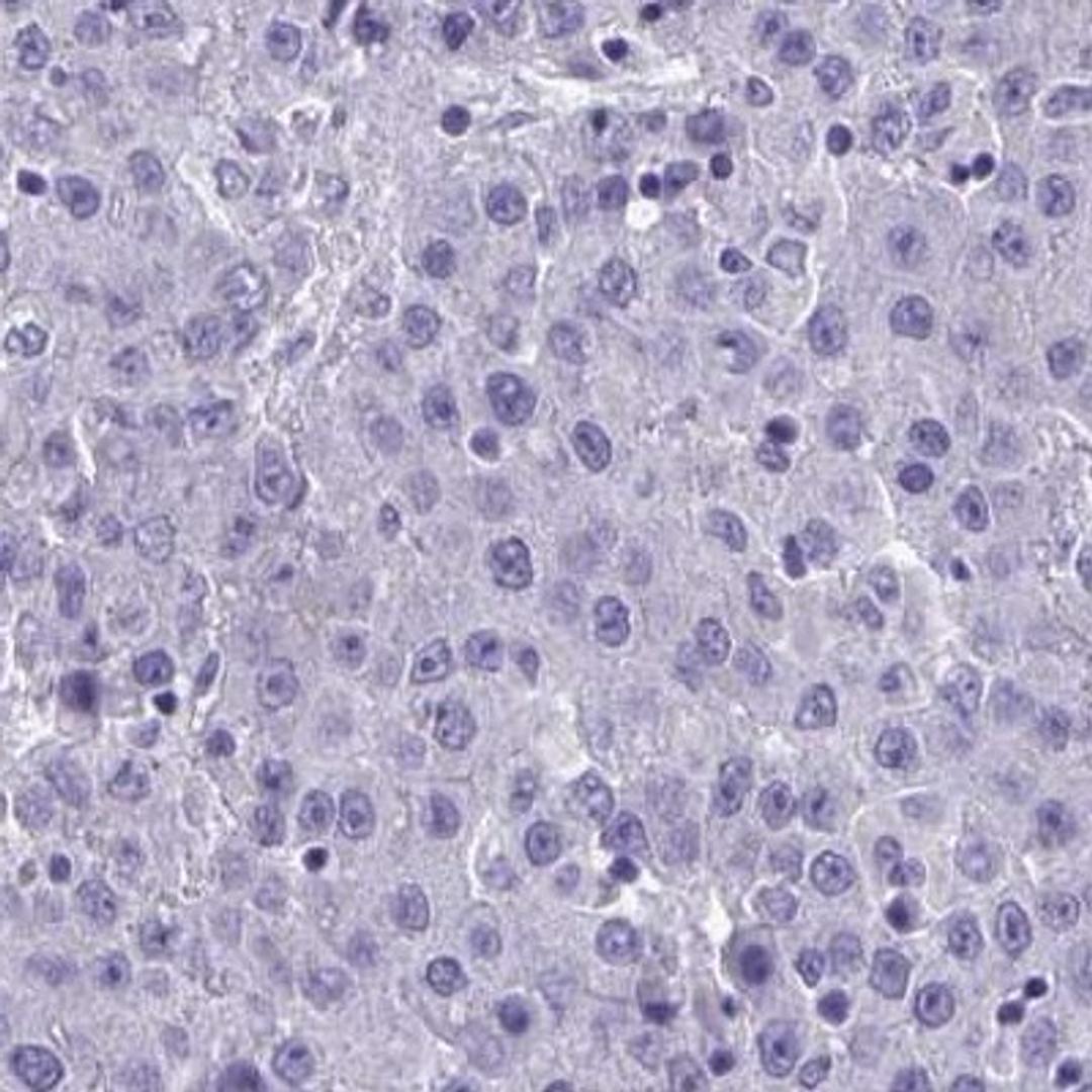 Immunohistochemistry: VGLL3 Antibody [NBP2-31590] - liver cancer