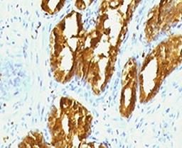 IHC testing of human prostate carcinoma with PSAP antibody (clone PSPN1-1).