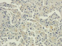 Immunohistochemical staining of human breast cancer tissue using anti-AHI1 (2.5 ug/ml)