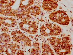 IHC image of CSB-PA010403PA05nforHU diluted at 1:20 and staining in paraffin-embedded human breast cancer performed on a Leica BondTM system. After dewaxing and hydration, antigen retrieval was mediated by high pressure in a citrate buffer (pH 6.0). Section was blocked with 10% normal goat serum 30min at RT. Then primary antibody (1% BSA) was incubated at 4°C overnight. The primary is detected by a biotinylated secondary antibody and visualized using an HRP conjugated SP system.