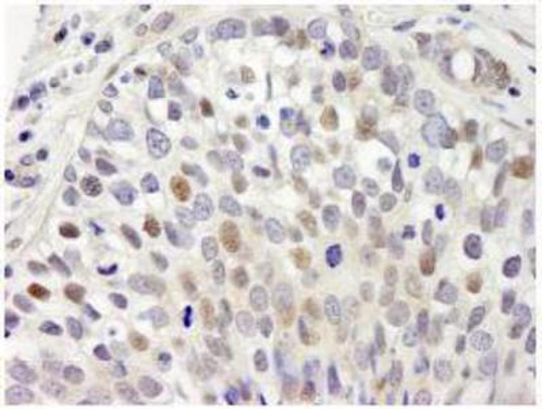 Immunohistochemistry-Paraffin: SETD1A Antibody [NB100-558] - Detection of Human hSET1 by Immunohistochemistry. Sample: FFPE section of human breast adenocarcinoma. Antibody: Affinity purified rabbit anti-hSET1 used at a dilution of 1:250. Detection: DAB staining using Immunohistochemistry Accessory Kit.