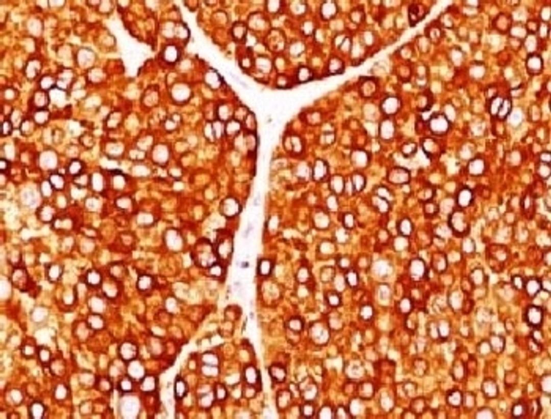 IHC testing of FFPE human melanoma with Tyrosinase antibody (clone TRSN1-1).