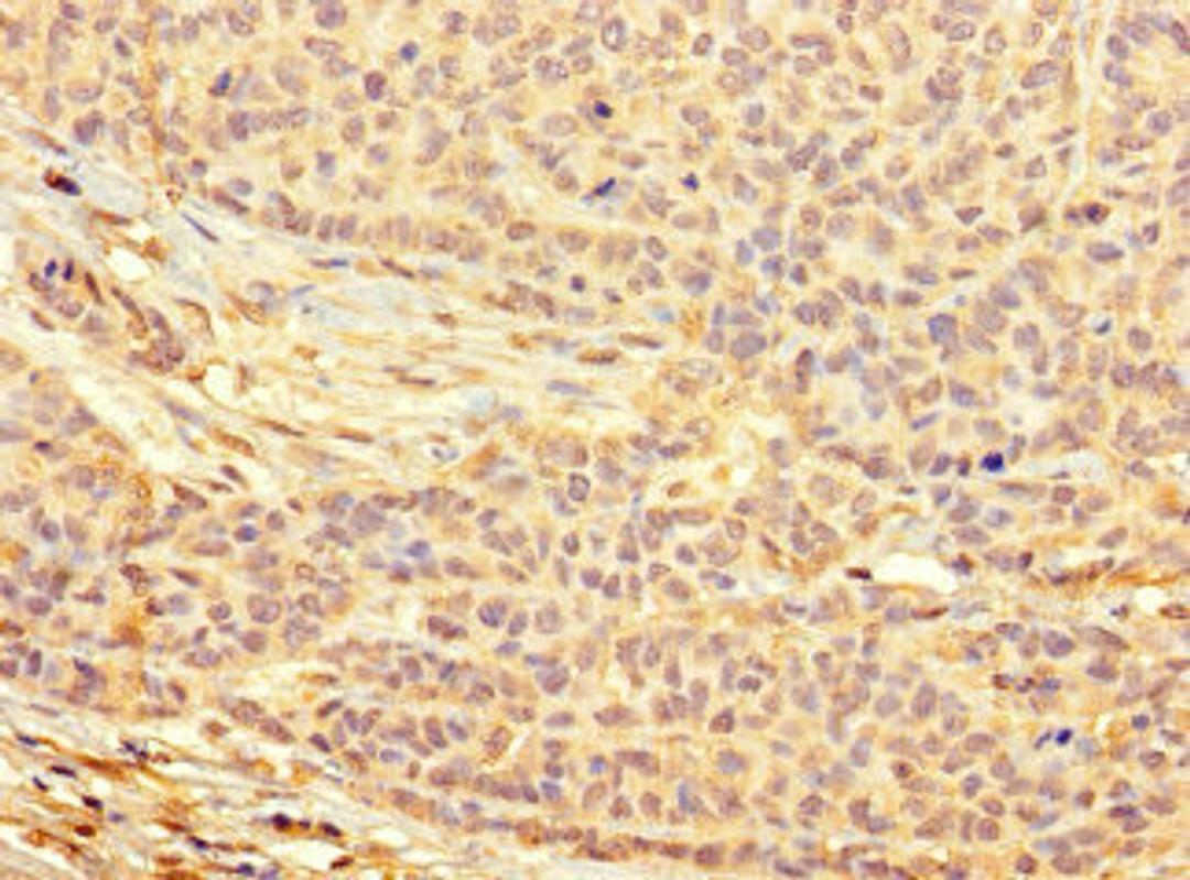 Immunohistochemistry of paraffin-embedded human ovarian cancer using CSB-PA733169LA01HU at dilution of 1:100