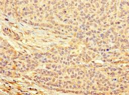 Immunohistochemistry of paraffin-embedded human ovarian cancer using CSB-PA733169LA01HU at dilution of 1:100