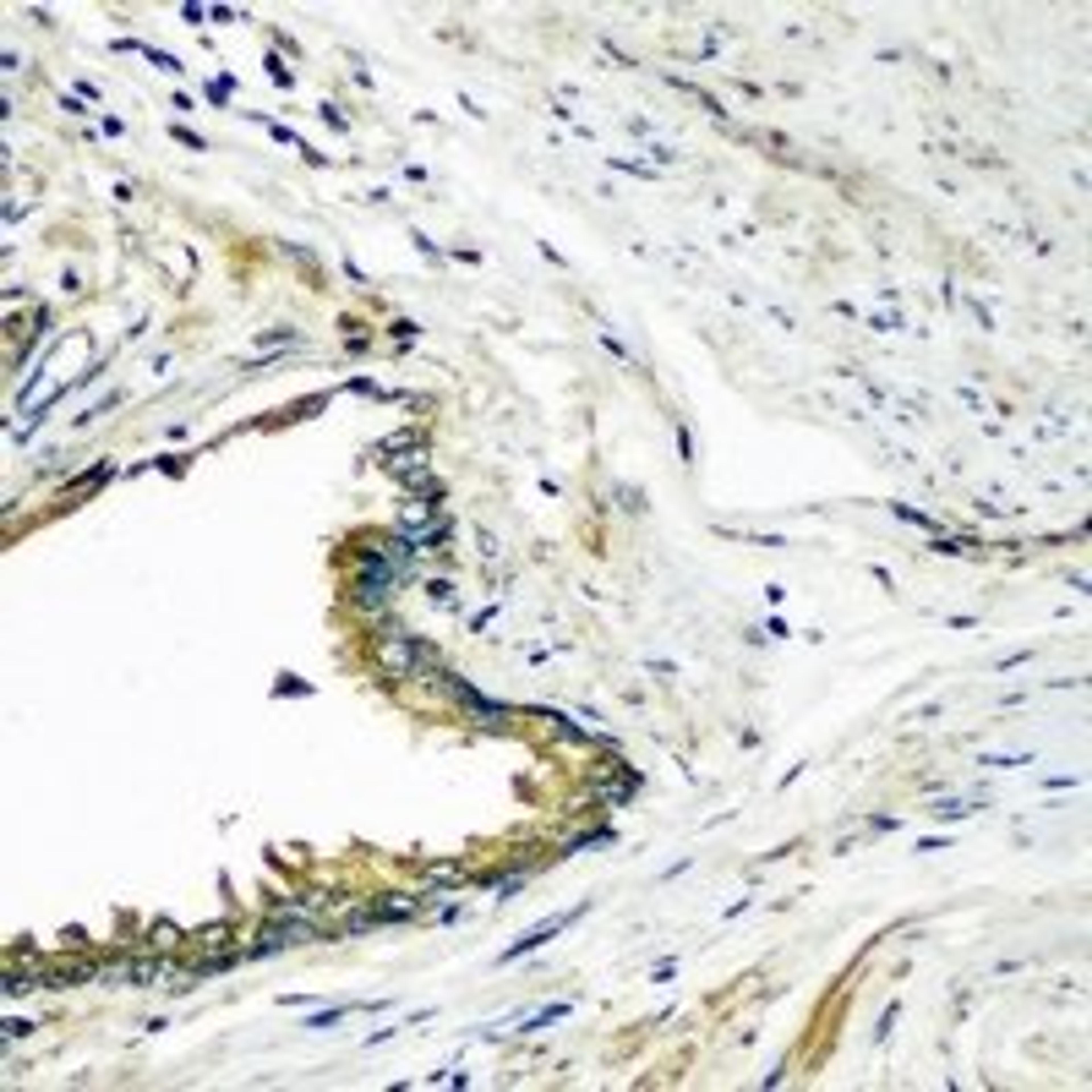 Immunohistochemical staining of human prostate cancer tissue using DEFB121 antibody