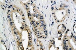 Immunohistochemical analysis of paraffin-embedded human colon cancer tissue using ROS antibody