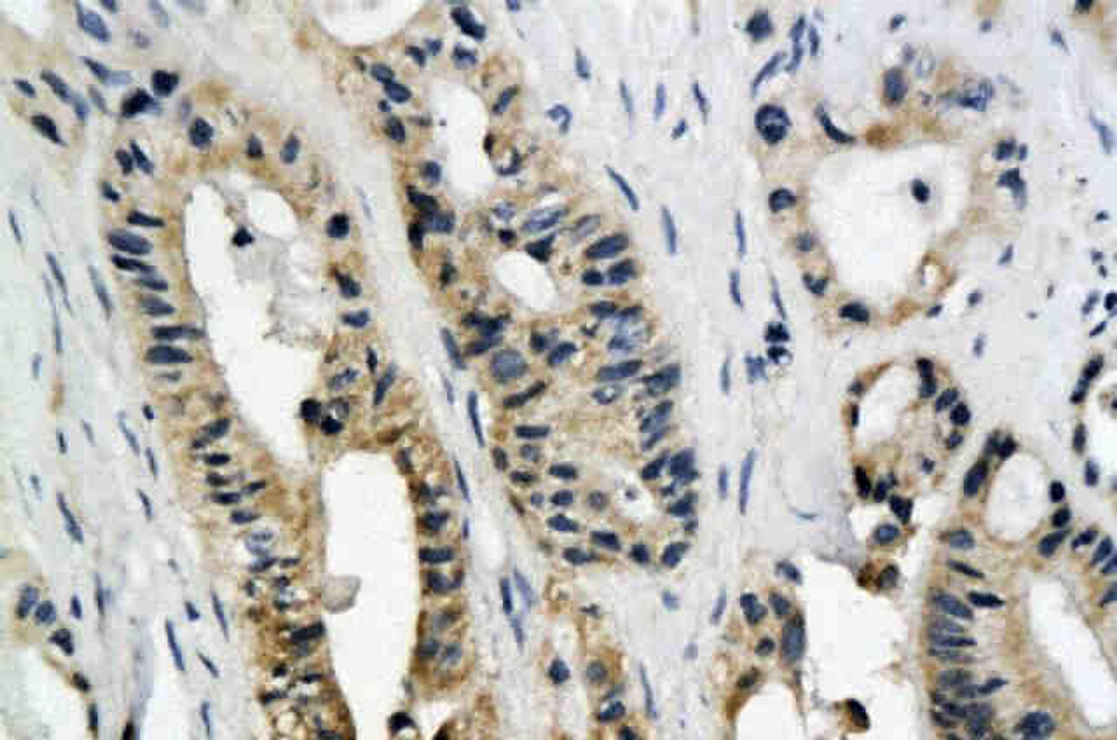 Immunohistochemical analysis of paraffin-embedded human colon cancer tissue using ROS antibody