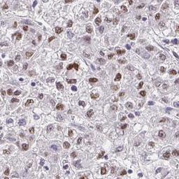 Immunohistochemistry: RIMS4 Antibody [NBP2-31842] - liver cancer