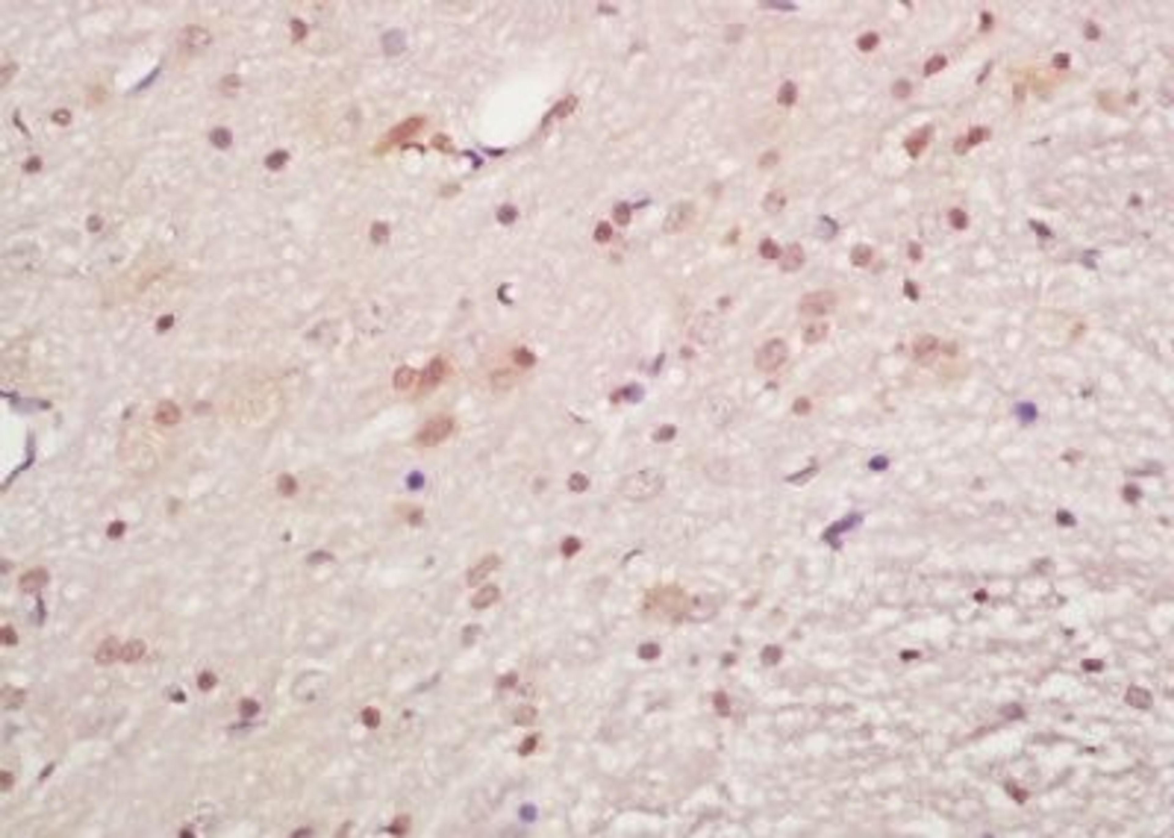 Immunohistochemical analysis of formalin-fixed paraffin embedded human lung carcinoma tissue using MAPKAPK5 (phospho-Ser93) antibody (dilution at 1:200)