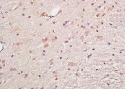 Immunohistochemical analysis of formalin-fixed paraffin embedded human lung carcinoma tissue using MAPKAPK5 (phospho-Ser93) antibody (dilution at 1:200)