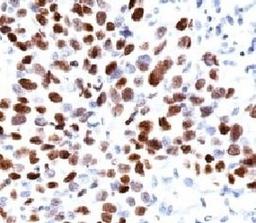 Formalin-fixed, paraffin-embedded human lung squamous cell carcinoma (SCC) stained with p21 antibody (CIP1/823).